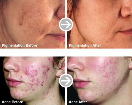 Skin peels before and after photos